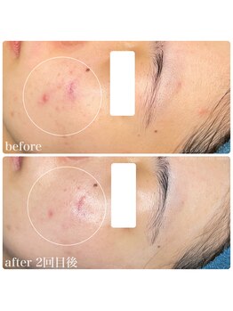 ちらちゅら/乳酸菌＋ハーブピーリング