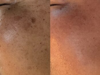 サラグランデ(Sara Grande)/しみケア５回施術！