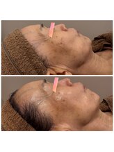 リリー(Rily)/生コラーゲンフェイシャル