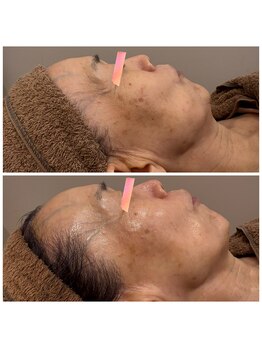 リリー(Rily)/生コラーゲンフェイシャル