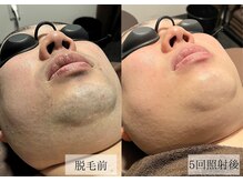 メンズアルファ/【髭】光脱毛before after 30代