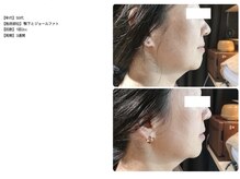 ラネージュ/レモンボトル3回。二重アゴ