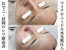 エステティック リベル キョウト 京都駅前店(Esthetic Liber Kyoto)/エステ版ポテンツァ水光肌注入