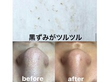ビューティーネイル(Beauty Nail)/毛穴エクストラクション