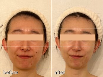 エビアス(Evias)/小顔マッサージ×筋膜リリース