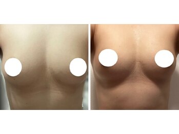 ベッピン(Beppin)/バストアップ症例写真