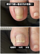 巻き爪じゅん 千葉駅前店/筒状で硬い巻き爪の痛みが改善