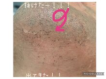 ヒゲ3回目　光を当てると出てくる！