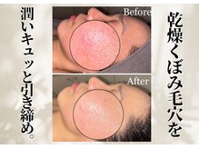 リリーシャ 赤坂(LILISHA)/オトナのたるみ毛穴はこれ一択！