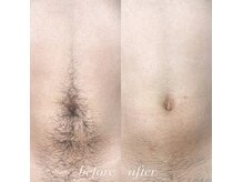 サンゴーハチ(358)/《全身脱毛》