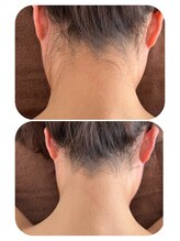 サロン ド メタセコイア(salon de Metasequoia)/THR脱毛方式／光脱毛