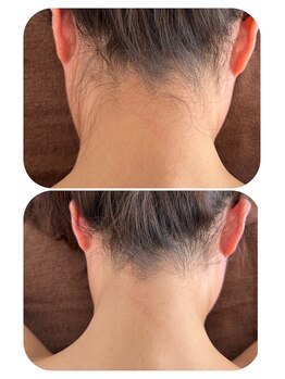 サロン ド メタセコイア(salon de Metasequoia)/THR脱毛方式／光脱毛