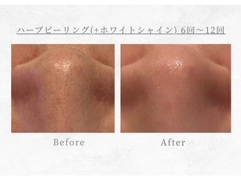 エヴァーグレース 三河安城店(EVER GRACE)/【肌管理】毛穴洗浄＋ハーブ