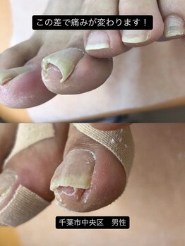 巻き爪じゅん 千葉駅前店/食い込む巻き爪を根本から変える