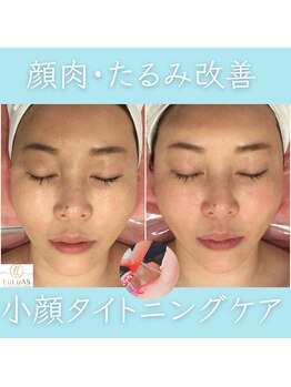 ルルアス 銀座(LuLuAS)/小顔|頬肉|二重顎フェイスライン