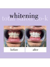 ヌック(NO-K)/ホワイトニング