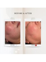 エクラ アン(eclat.un)/５０代女性：毛穴スペシャル