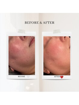 エクラ アン(eclat.un)/５０代女性：毛穴スペシャル