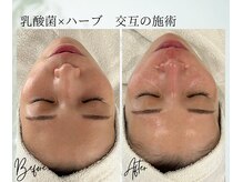 ポノ 茅ヶ崎(Pono.)/茅ケ崎/湘南/脱毛/毛穴/ハーブ