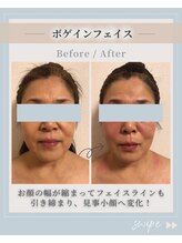 オディエ(Odier)/ボゲインフェイスで小顔、造顔