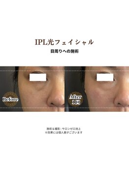 サロンゼロ 池上店(Salon ZERO)/IPL光フェイシャルでたるみ改善
