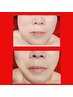 【看護師様　関係者限定】応援♪たるみケア/小顔ケア/リフトアップ/美肌¥3350