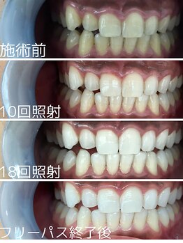 ホワイトニングサロン 京都烏丸店/ホワイトニング施術例