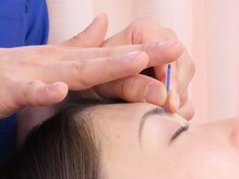 F.C.C.あやせ鍼灸整骨院/眼精疲労【綾瀬/鍼灸】