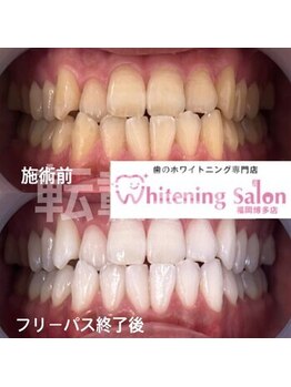 ホワイトニングサロン 福岡博多店/ホワイトニング