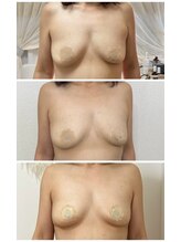 エルミナ.(elmina.)/産後の下垂悩み改善中！