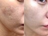 【脱凸凹肌】ファンデでごまかさない素肌へ★プラズマ+美容液導入+パック付き