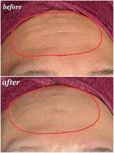 ソルエユニーク(Le seul et unique)/おでこにハリが出てシワ改善★