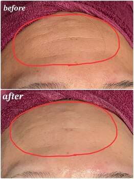 ソルエユニーク(Le seul et unique)/おでこにハリが出てシワ改善★