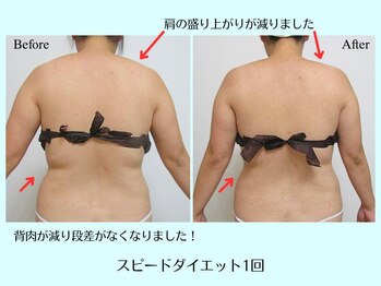 リクラ(Reclat)/スピードダイエット1回