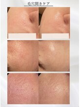 ビジュープラス 水戸店(Bijou+)&nbsp;毛穴開き 肌改善◎