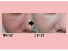 クレエ(Cre’er)/脱毛以外のメニューも☆