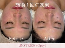 芯美 恵比寿店(shinbi)/UNSTRESS×Optyl(高密度超音波)