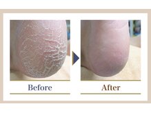 巻き爪補正店 越谷店の雰囲気(夏に向け踵のガサガサケアをしませんか?1度の施術でつるつる!)