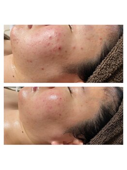 ホズリル(Hozril)/お肌改善