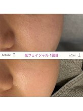 キュオバイアンドリープ(Qo by &LEAP)/光フェイシャル/beforeafter
