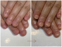 ネイルズシアム/【深爪矯正】見た目改善ネイル
