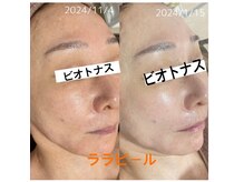 ビオトナス(Facial Esthe)/大人気ララピール