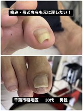 巻き爪じゅん 船橋店/巻き爪矯正で痛み形が大きく改善