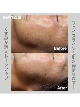 ヴィヴ フォー アール(VIV for R)/しわ・たるみ改善 70代女性