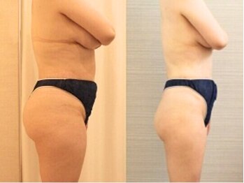 ファニービー 吹田店/ぷにぷにお腹撃退！！