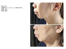 ラネージュ/レモンボトル3回。口横ぽにょ