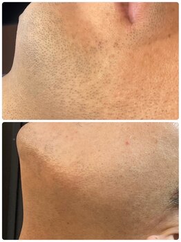 ムーモー 横浜関内店(mu_mo_)/脱毛効果2