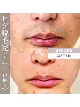 メンズラボ 京都駅前店/髭脱毛ビフォーアフター◎