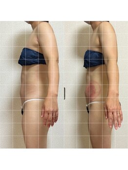 リノリー 一関店(rinory)/「お腹集中!脂肪冷却」