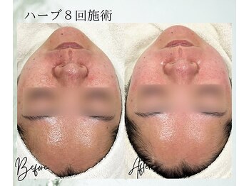 ポノ 茅ヶ崎(Pono.)/茅ケ崎/湘南/脱毛/毛穴/ハーブ